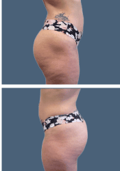 After brazilian butt lift (bbl)