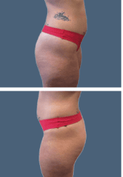 Before brazilian butt lift (bbl)