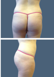 After brazilian butt lift (bbl)