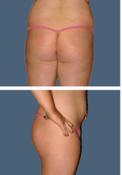Before brazilian butt lift (bbl)