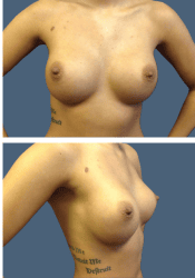 After breast augmentation, 400cc, A to D cup