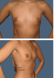 Before breast augmentation, 400cc, A to D cup