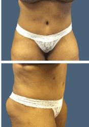 After body