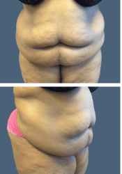 Before body