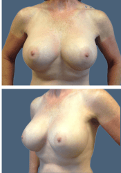 After breast augmentation, 500cc, B to D cup