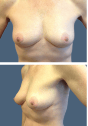 Before breast augmentation, 500cc, B to D cup