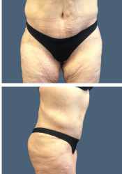 After body