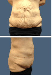 Before body