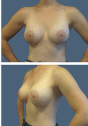 After breast augmentation, 360cc, A to D cup