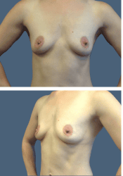 Before breast augmentation, 360cc, A to D cup
