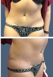 After body