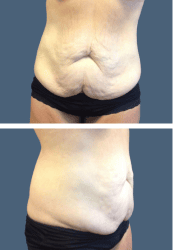 Before body