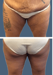 Before body