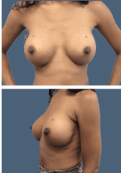 After breast augmentation, 500cc, B to D cup