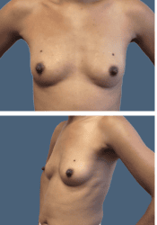 Before breast augmentation, 500cc, B to D cup