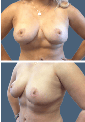 After breast reduction, D to C cup