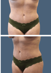 After body