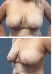 Before breast reduction, D to C cup