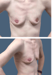 Before breast augmentation, 500cc, A to C cup