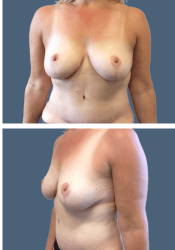 After breast reduction, E to C cup