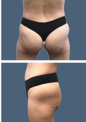 After brazilian butt lift (bbl)