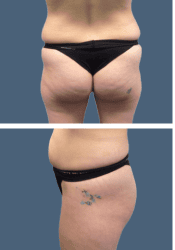 Before brazilian butt lift (bbl)