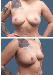 After breast