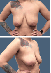 Before breast