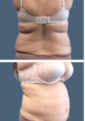 Before body