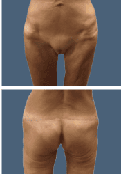 After body