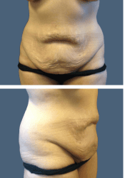 Tummy Tuck - Before