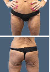 Before body