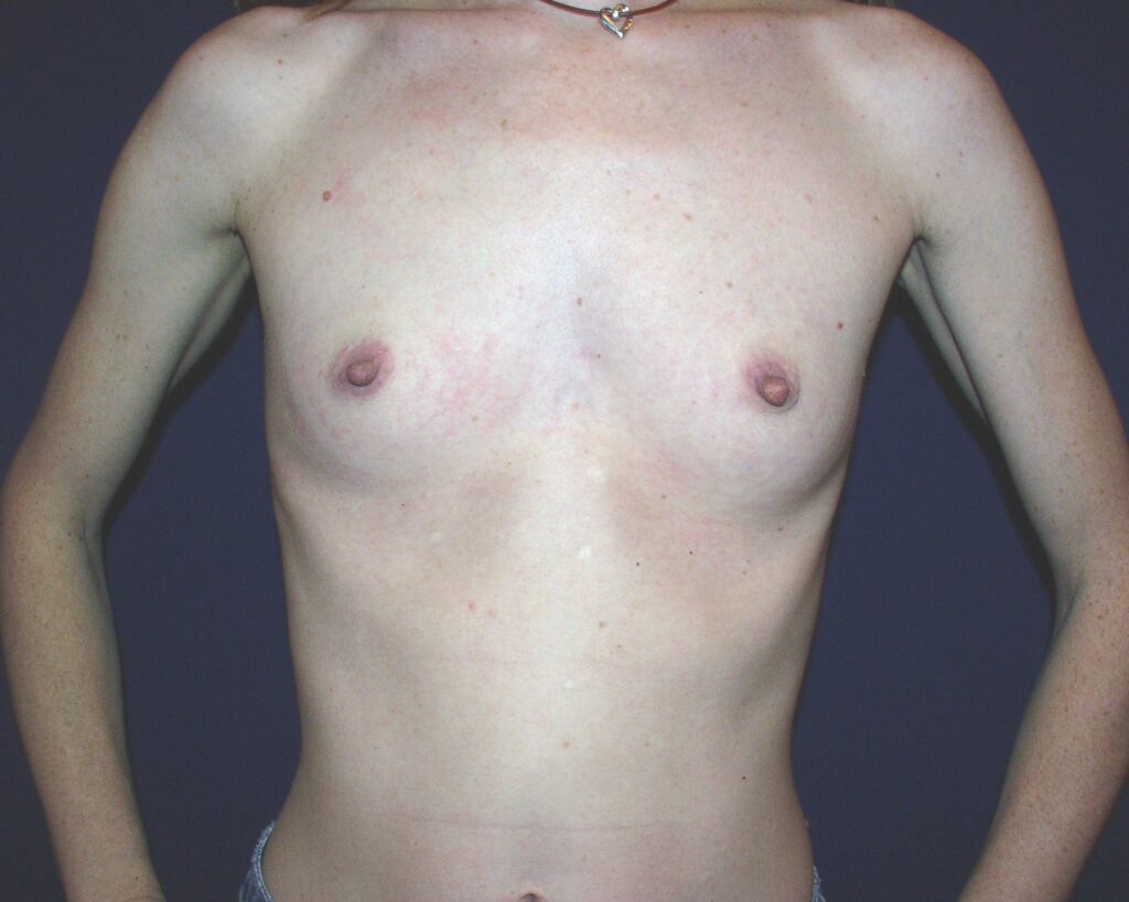 Before breast augmentation, 350cc, AA to C cup