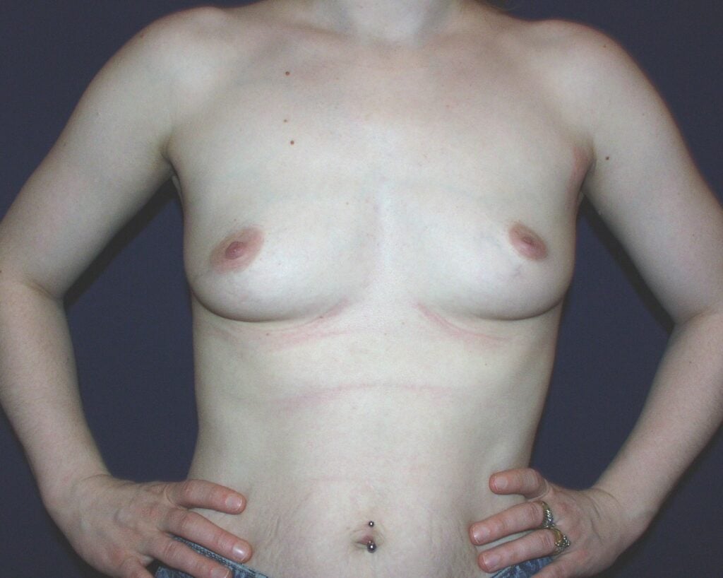 Before breast augmentation, 450cc, B to D cup