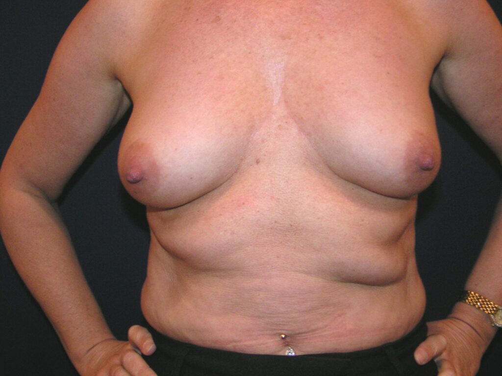 Before breast augmentation, 300cc, A to C cup