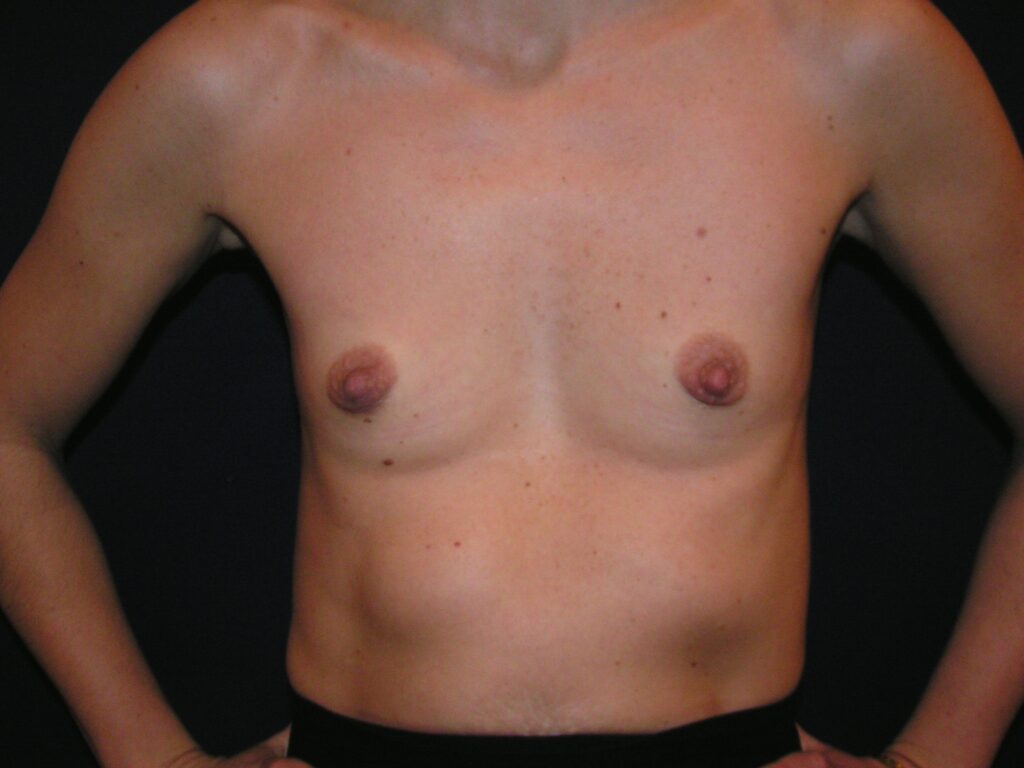 Before breast augmentation, 350cc, A to C cup