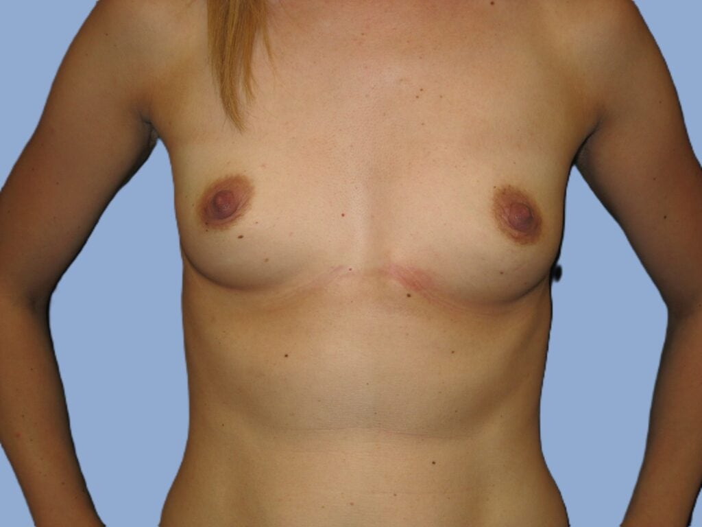 Before breast augmentation, 595cc, A to DD cup