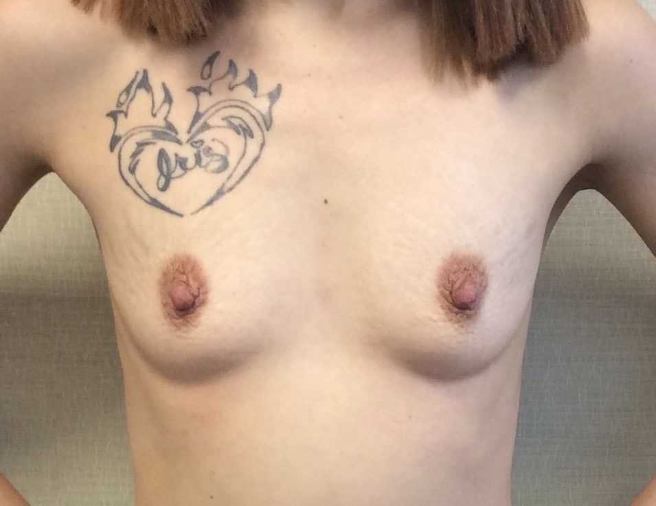 Before breast augmentation, 500cc, A to D cup